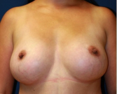 Feel Beautiful - Breast Augmentation 137 - After Photo
